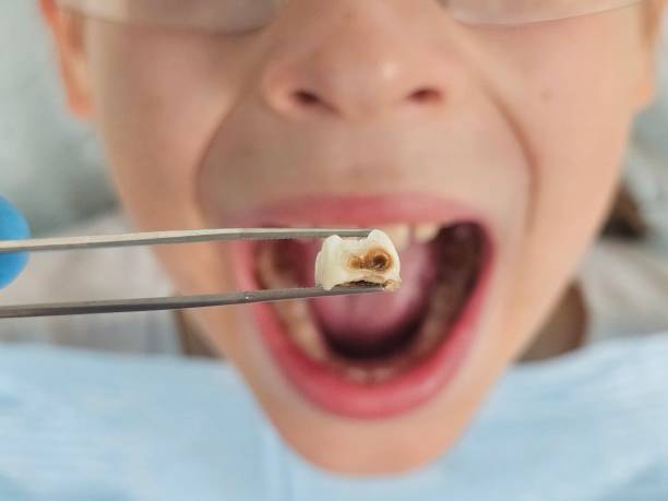 Best Emergency Tooth Extraction  in Woodworth, LA