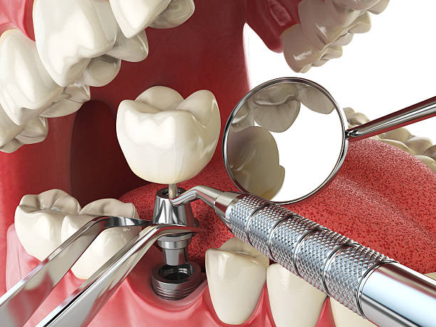 Best Teeth Whitening  in Woodworth, LA
